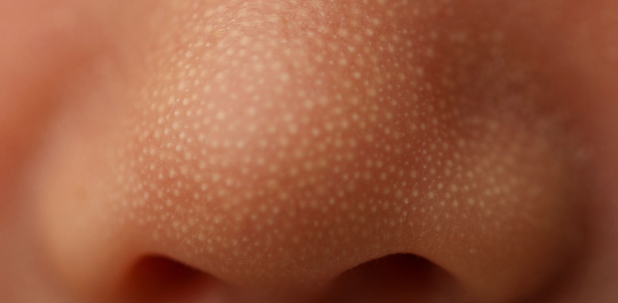 Baby mit vergößerten Talgdrüsen an der Nase