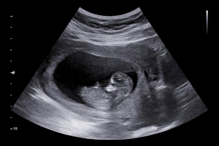 Ultraschallbild Baby 12 Wochen