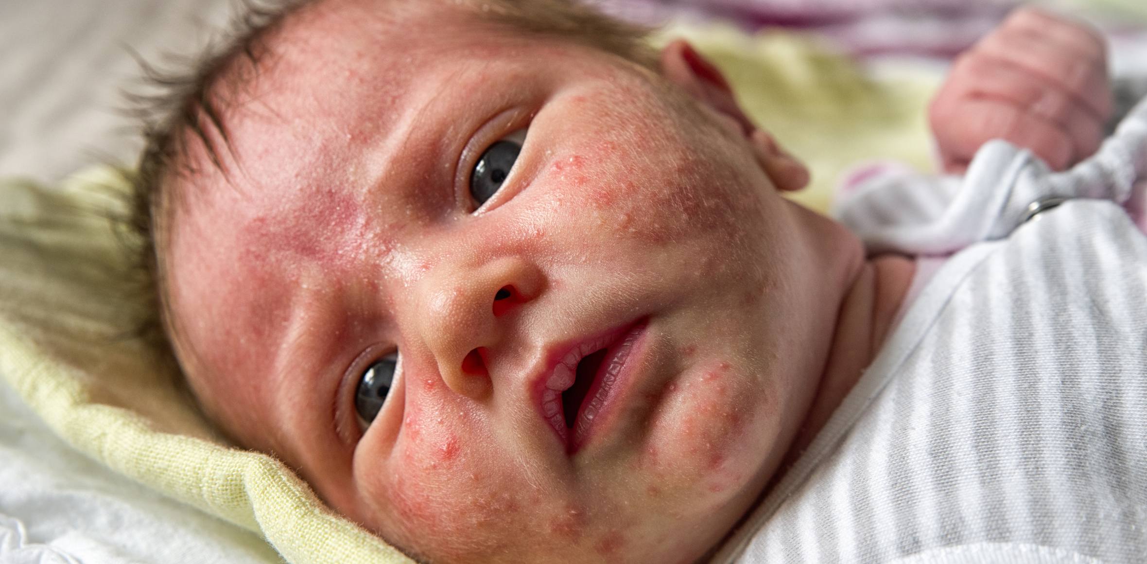 Baby Gesicht mit echter Neugeborenen Akne