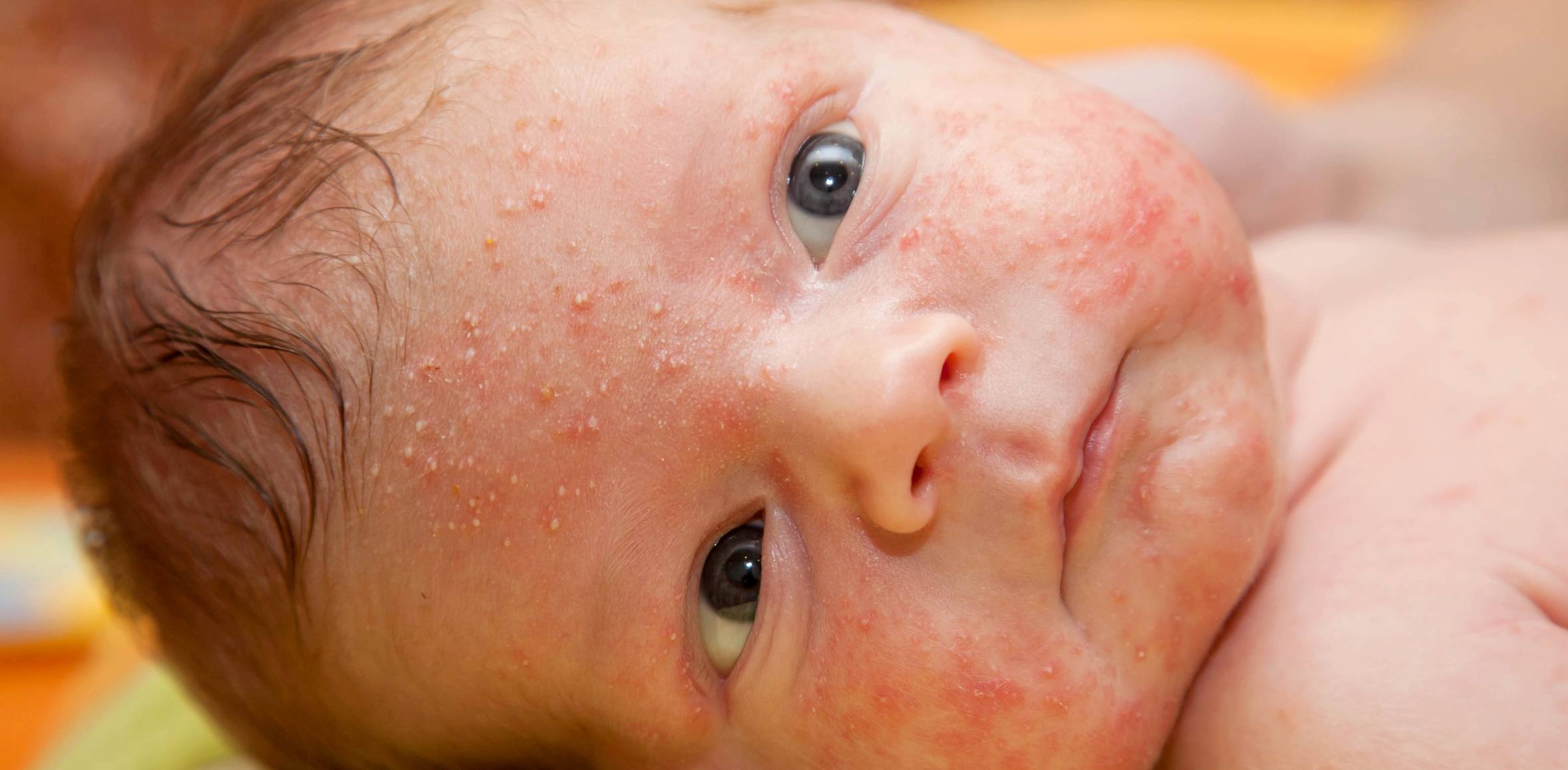 Baby Gesicht mit Pityrosporumfollikulitis