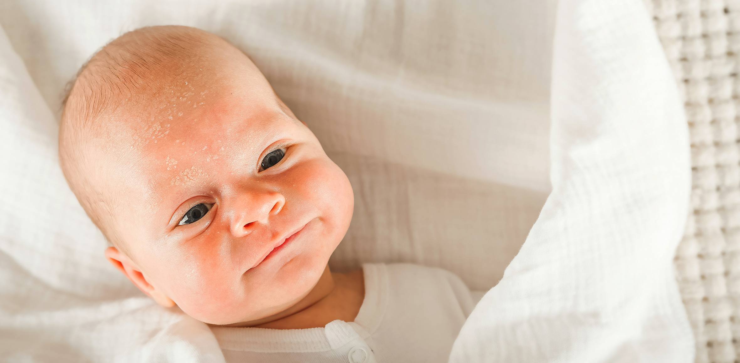 Baby Gesicht mit Seborrhoischer Dermatitis