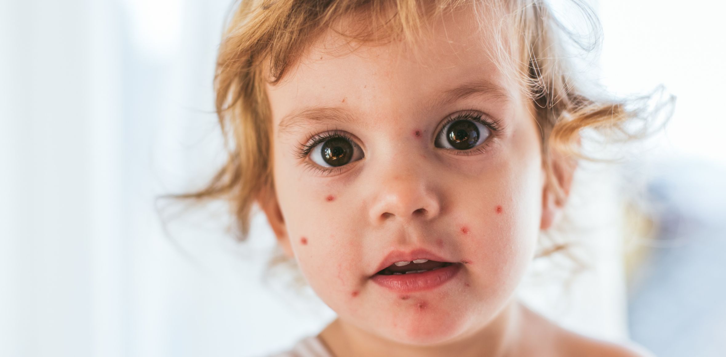 Hautveränderungen bei Kindern Kind mit Windpocken
