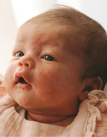 baby-mit-babyakne