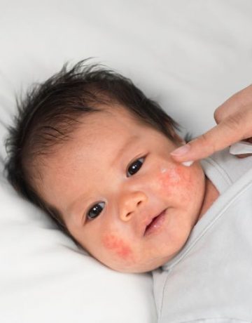 atopic-dermatitis-in-infants