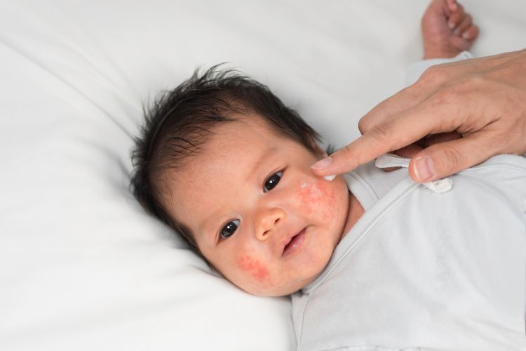 atopic-dermatitis-in-infants