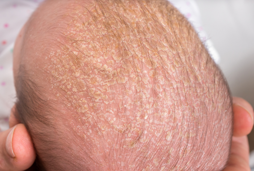 baby-skin-first-weeks-of-life-cephalic-gneiss
