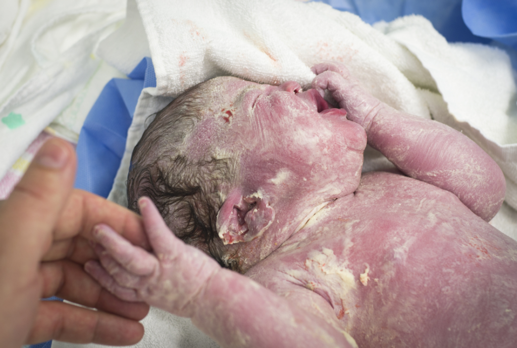 baby-skin-first-weeks-of-life-cheese-smear