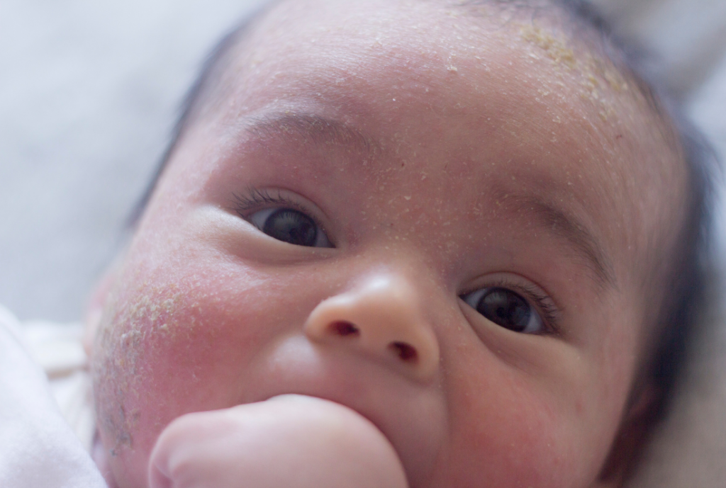 baby-skin-first-weeks-of-life-cradle-cap