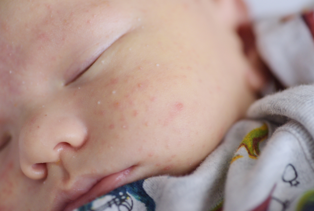 baby-skin-first-weeks-of-life-milia
