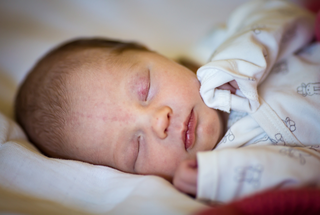 baby-skin-first-weeks-of-life-stork-bites